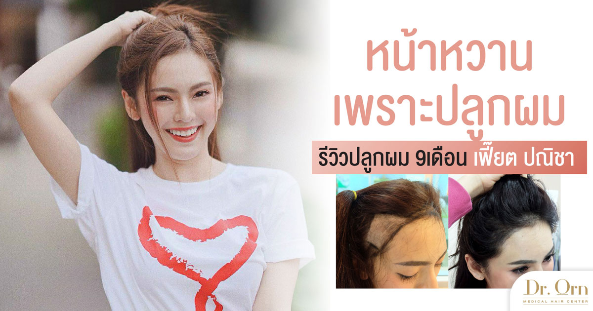 หน้าหวานขึ้นได้ด้วยการปลูกผม เฟี๊ยต ปณิชาปลูกผมผู้หญิง