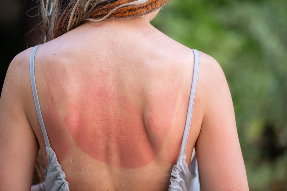 A woman with sun damaged skin on her back